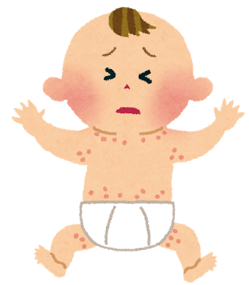 お子様の皮膚疾患について うえせこどもクリニック